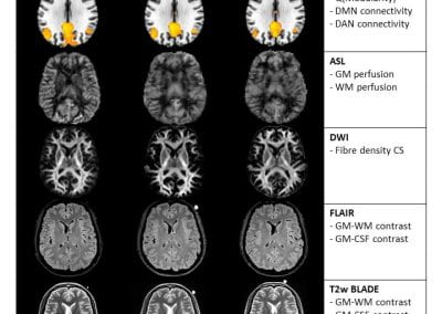 Travelling Heads – Measuring Reproducibility and Repeatability of Magnetic Resonance Imaging in Dementia